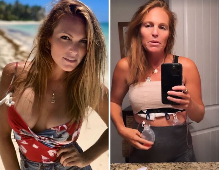 20 Celebs Had Their Breast Implants Removed