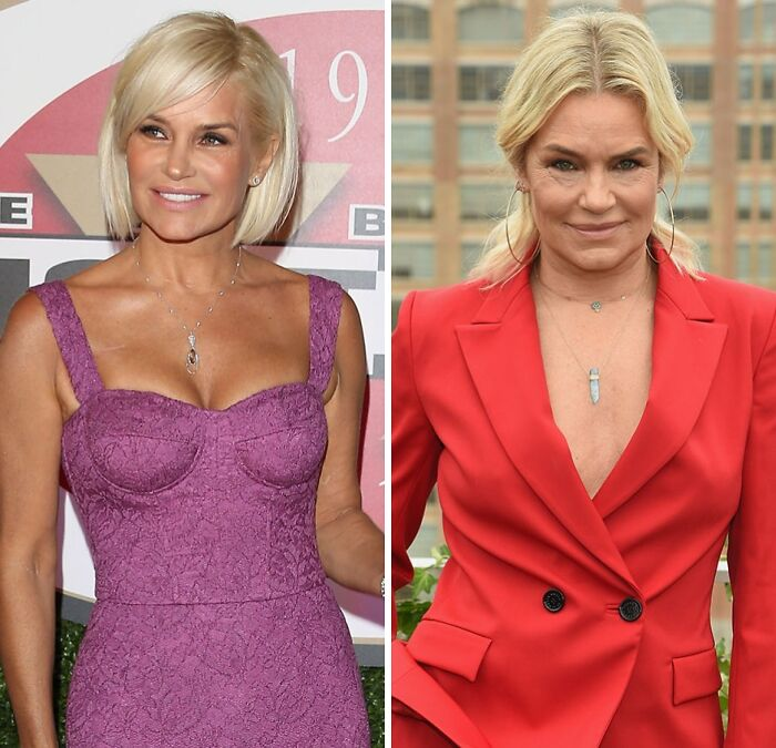 20 Celebs Had Their Breast Implants Removed